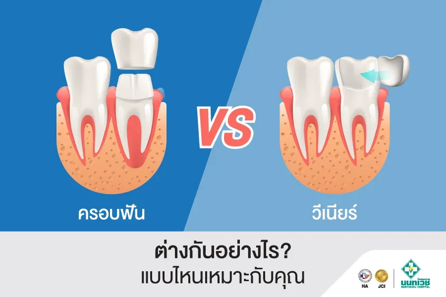ครอบฟัน กับ วีเนียร์ ต่างกันอย่างไร อันไหนดีกว่ากัน?