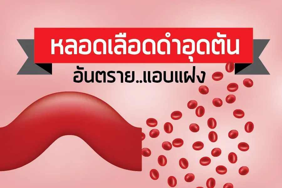 หลอดเลือดดำอุดตัน อันตราย..แอบแฝง