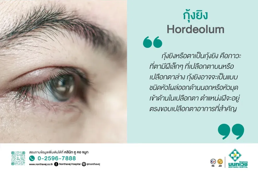 กุ้งยิง Hordeolum