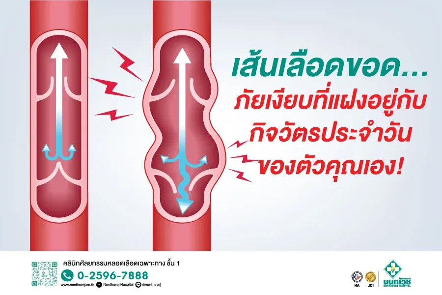 โรคเส้นเลือดขอด