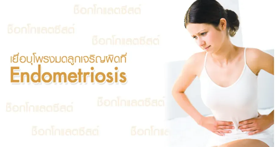 ช็อกโกแลตซีสต์ หรือ เยื่อบุโพรงมดลูกเจริญขึ้นผิดที่ Endometriosis