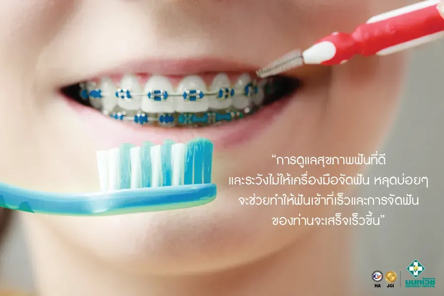 วิธีทำความสะอาดฟัน "เมื่อจัดฟัน"